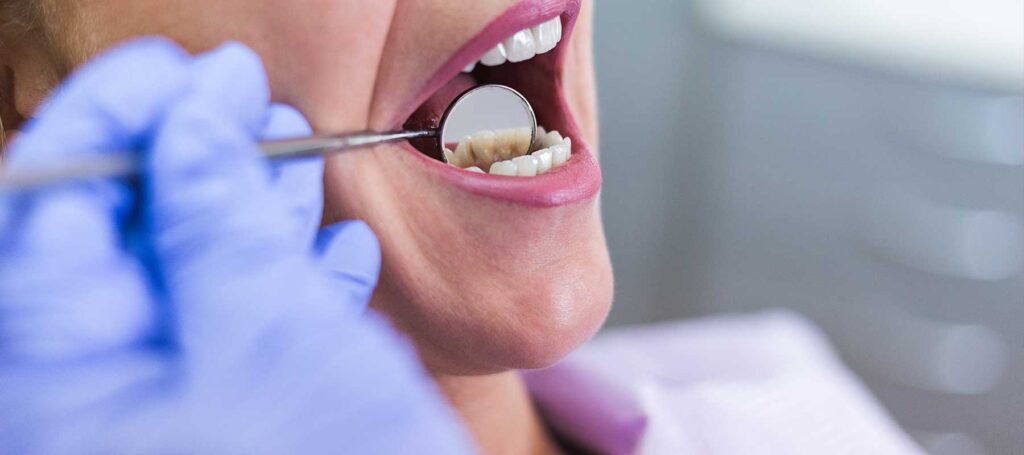 how long should you wait to exercise after tooth extraction